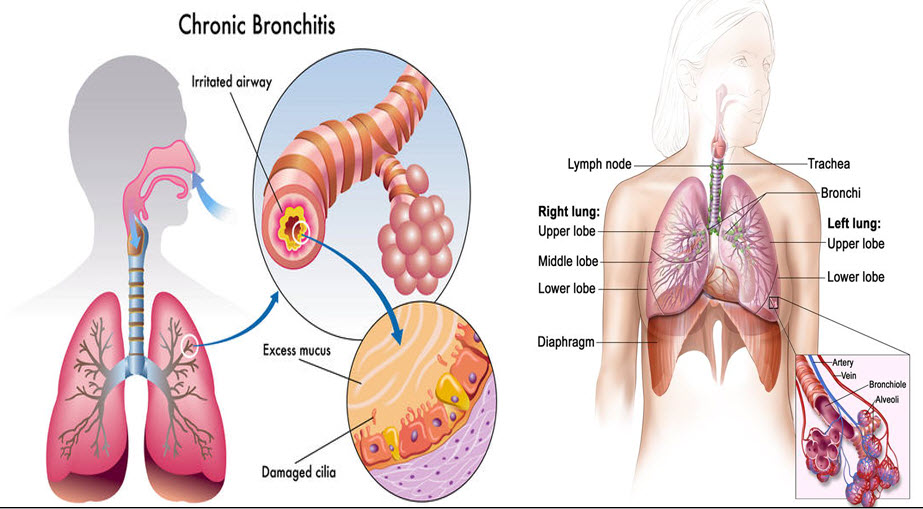 Lung Cancers And Bronchitis